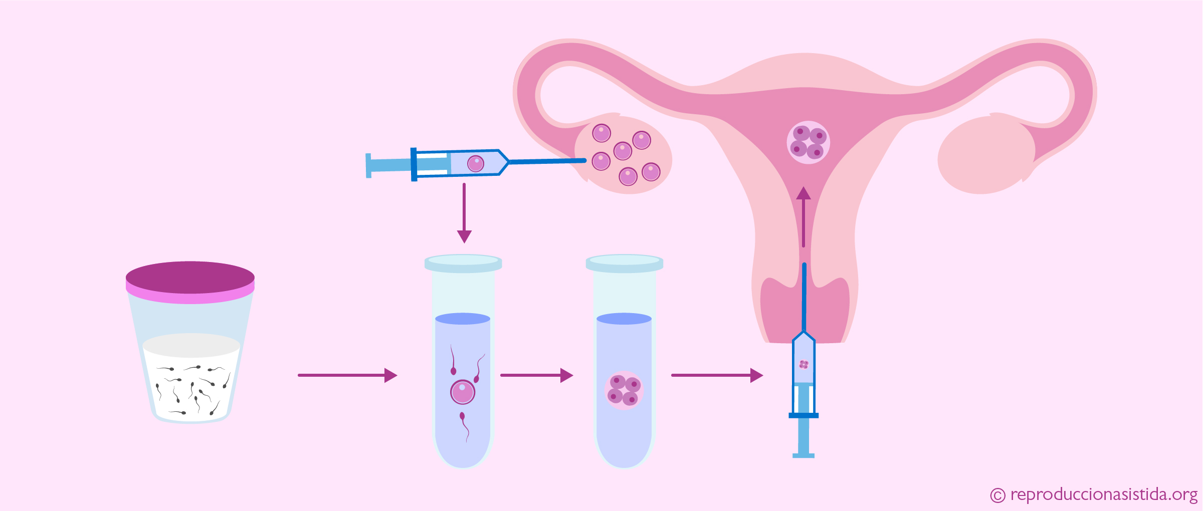 Fecundación In vitro